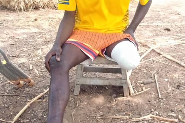 Access to Prosthetic Leg (Artificial Limb) for Needy Person with Disability